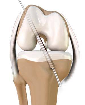 Achilles Tendon Repair