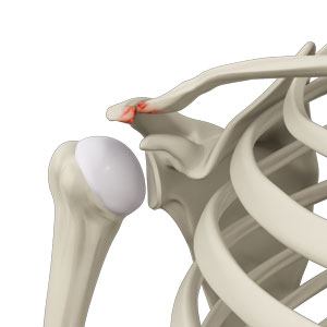 ACROMIOCLAVICULAR (AC) ARTHRITIS