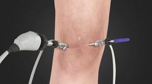 Arthroscopic Surgery