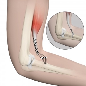 Distal Biceps Injuries