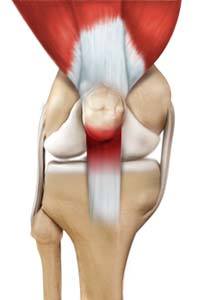 Jumper's Knee/Patellar Tendinitis