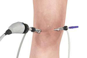 Arthroscopic Knee Surgery 