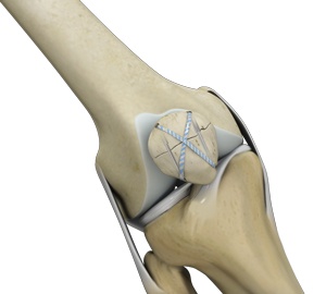 Knee Fracture Surgery 