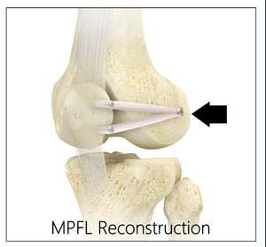 Medial Patellofemoral Ligament (MPFL) Reconstruction 