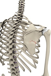 Fracture Scapula