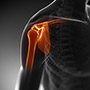 Arthroscopic Rotator Cuff Repair