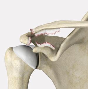 Shoulder Ligament Injuries