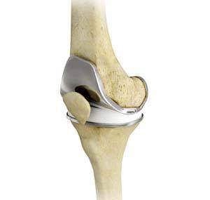 Total Knee Arthroplasty /Total Knee Replacement