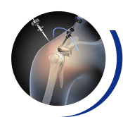 Arthroscopic Shoulder Surgery