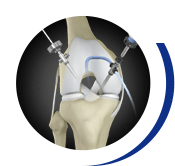 Arthroscopic Knee  Surgery