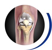 Knee Joint Replacement